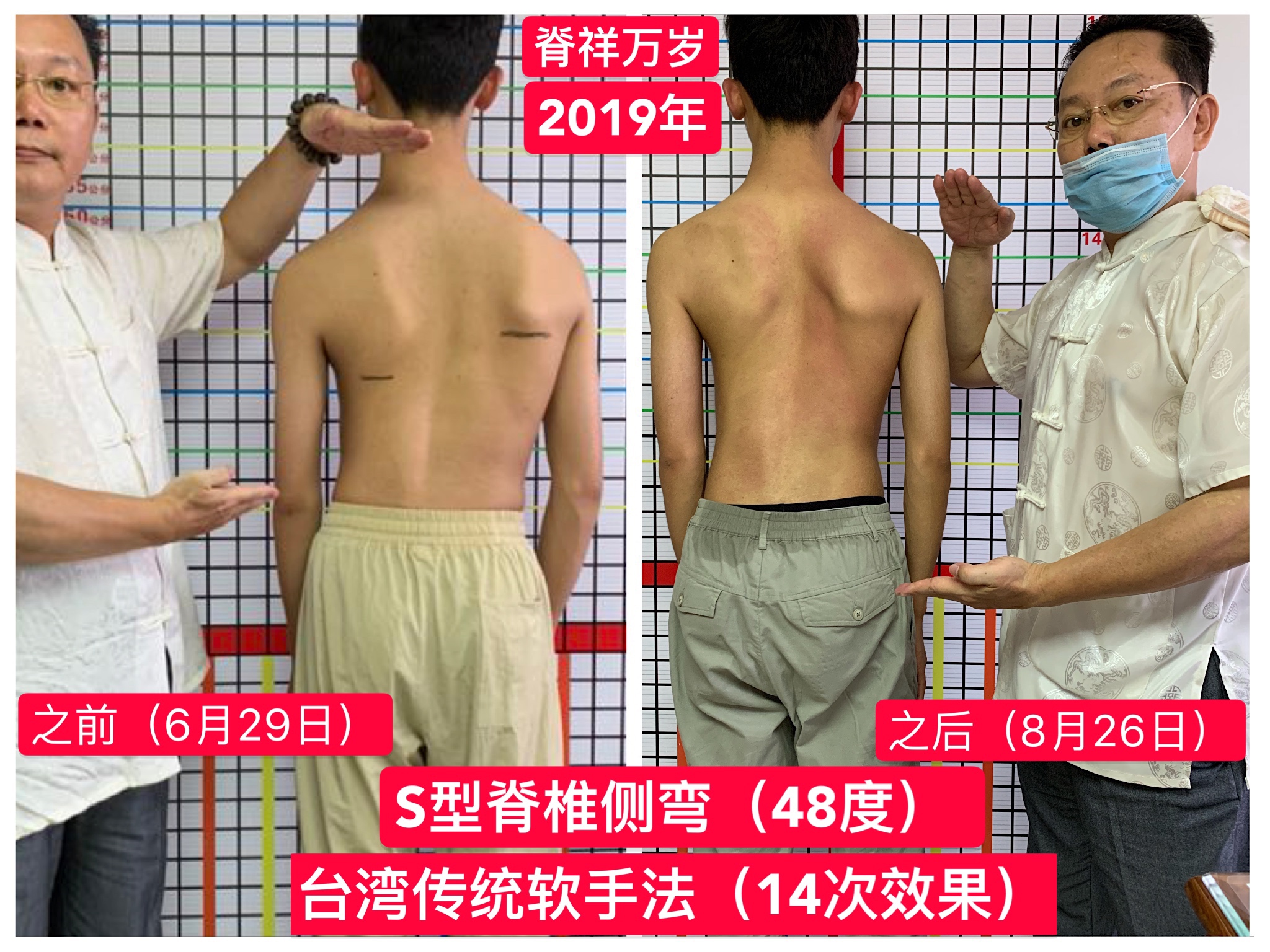 科学的脊柱侧弯治疗方法简介 - 知乎